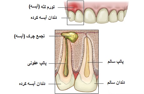 درمان عفونت دندان کودکان