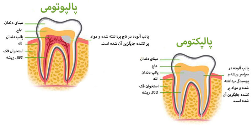 پالپکتومی دندان شیری چیست