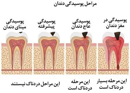 درد دندان بعد از عصب کشی در کودکان