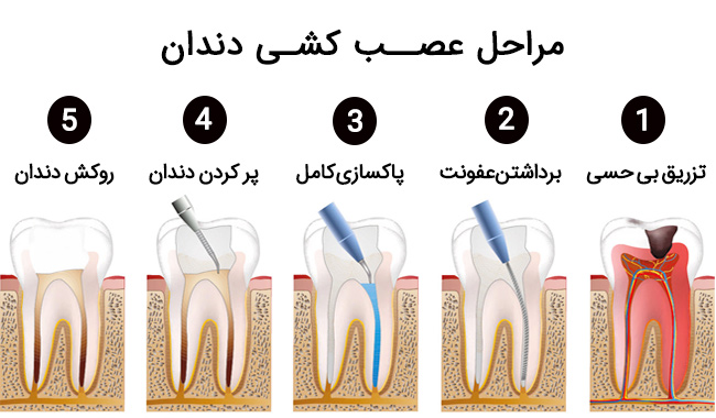 درد دندان بعد از عصب کشی در کودکان