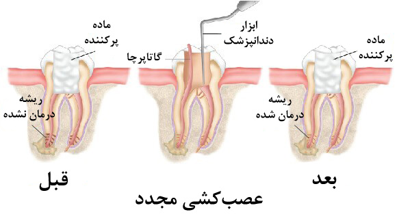 درد دندان بعد از عصب کشی در کودکان