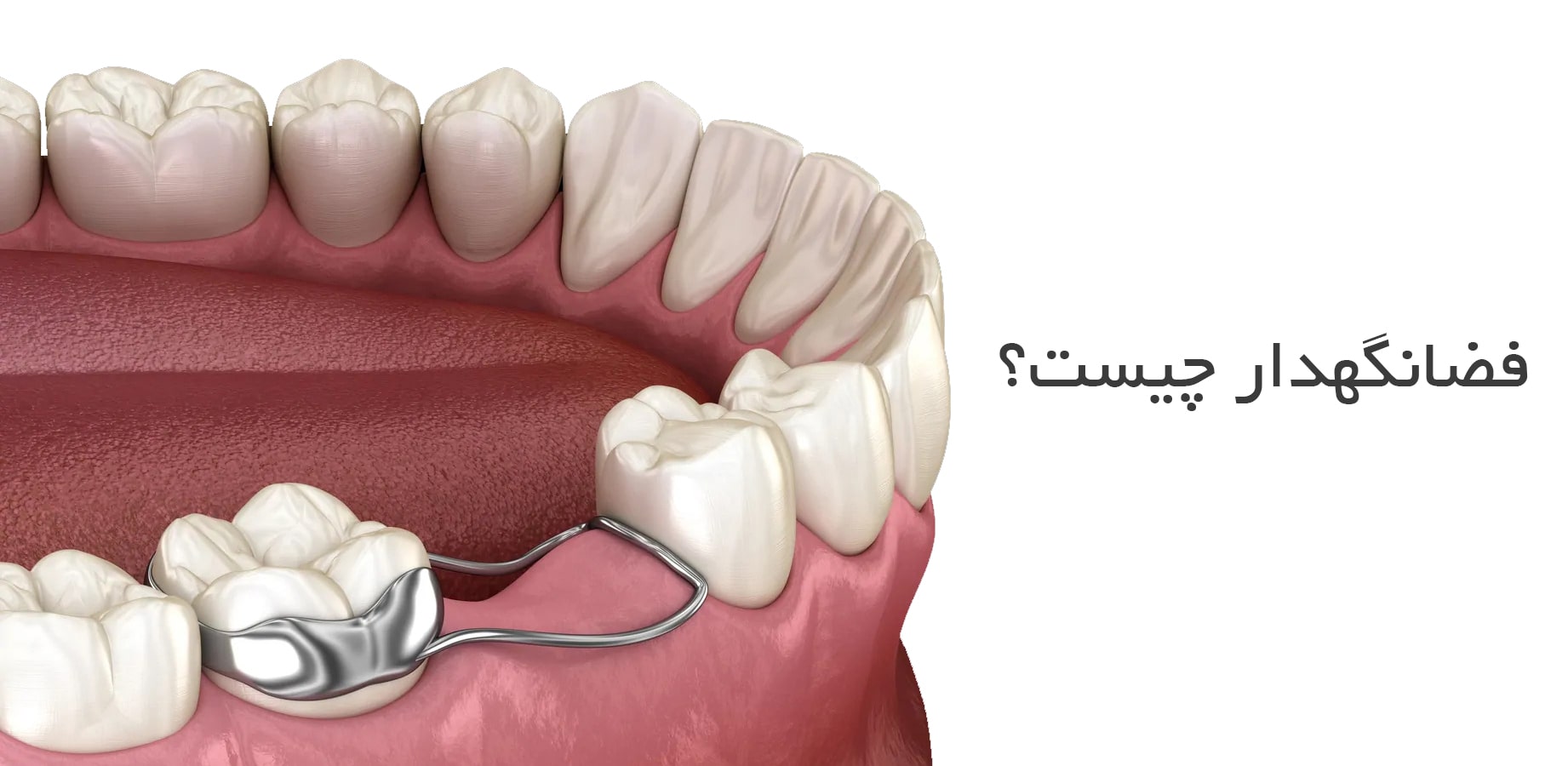 انواع فضا نگهدار دندان کودکان