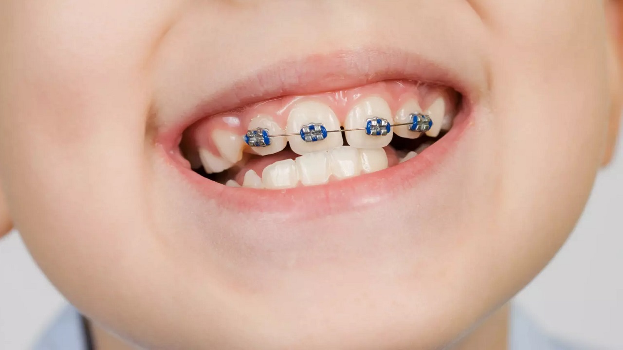 چگونه زمان ارتودنسی را کاهش دهیم
