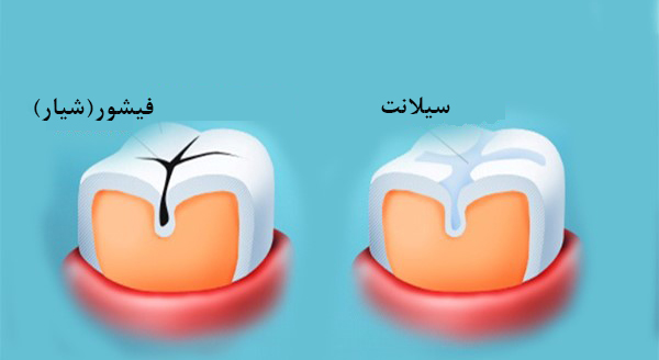 شیار پوش دندان کودک یا فیشور سیلانت چیست؟