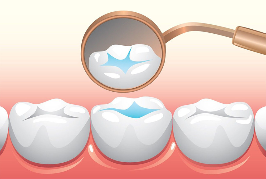 شیار پوش دندان کودک یا فیشور سیلانت چیست؟