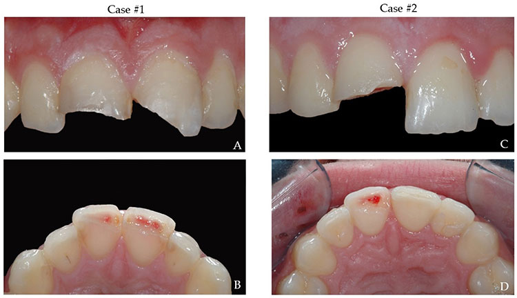 لب پر شدن دندان شیری کودک