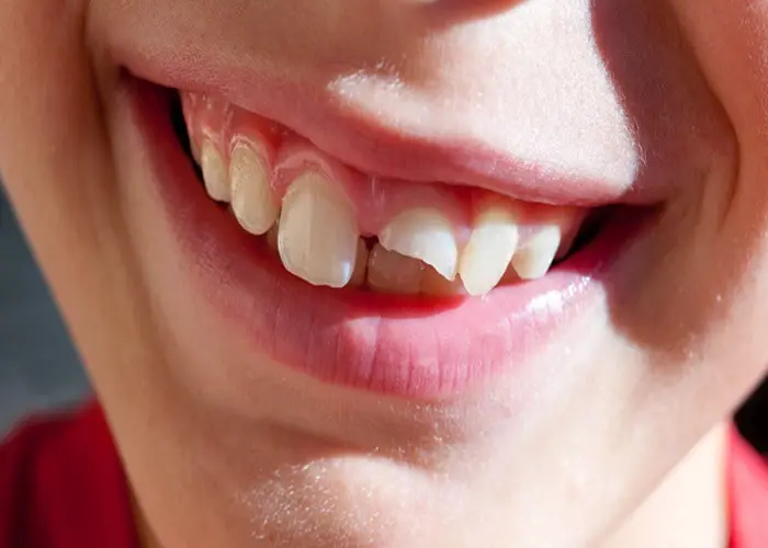 لب پر شدن دندان شیری کودک