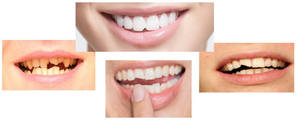 لب پر شدن دندان شیری کودک