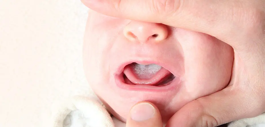 برفک دهان نوزاد