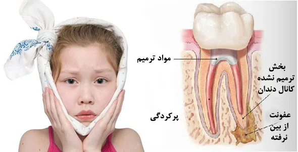 آیا عصب کشی دندان شیری درد دارد؟