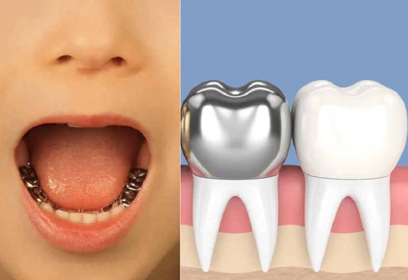 روکش زیرکونیا دندان شیری چیست؟