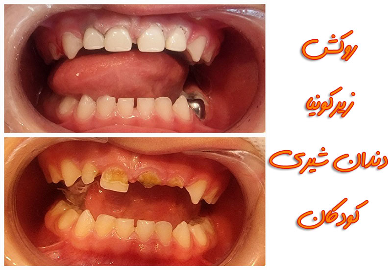 روکش زیرکونیا دندان شیری چیست؟